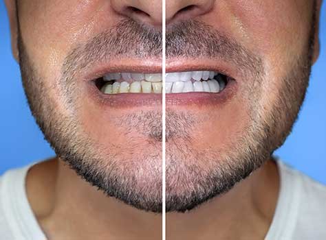 Invisalign aligners