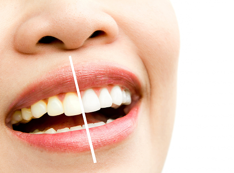 Teeth Whitening vs Cleaning