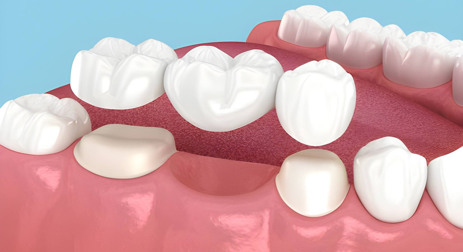 dental bridges