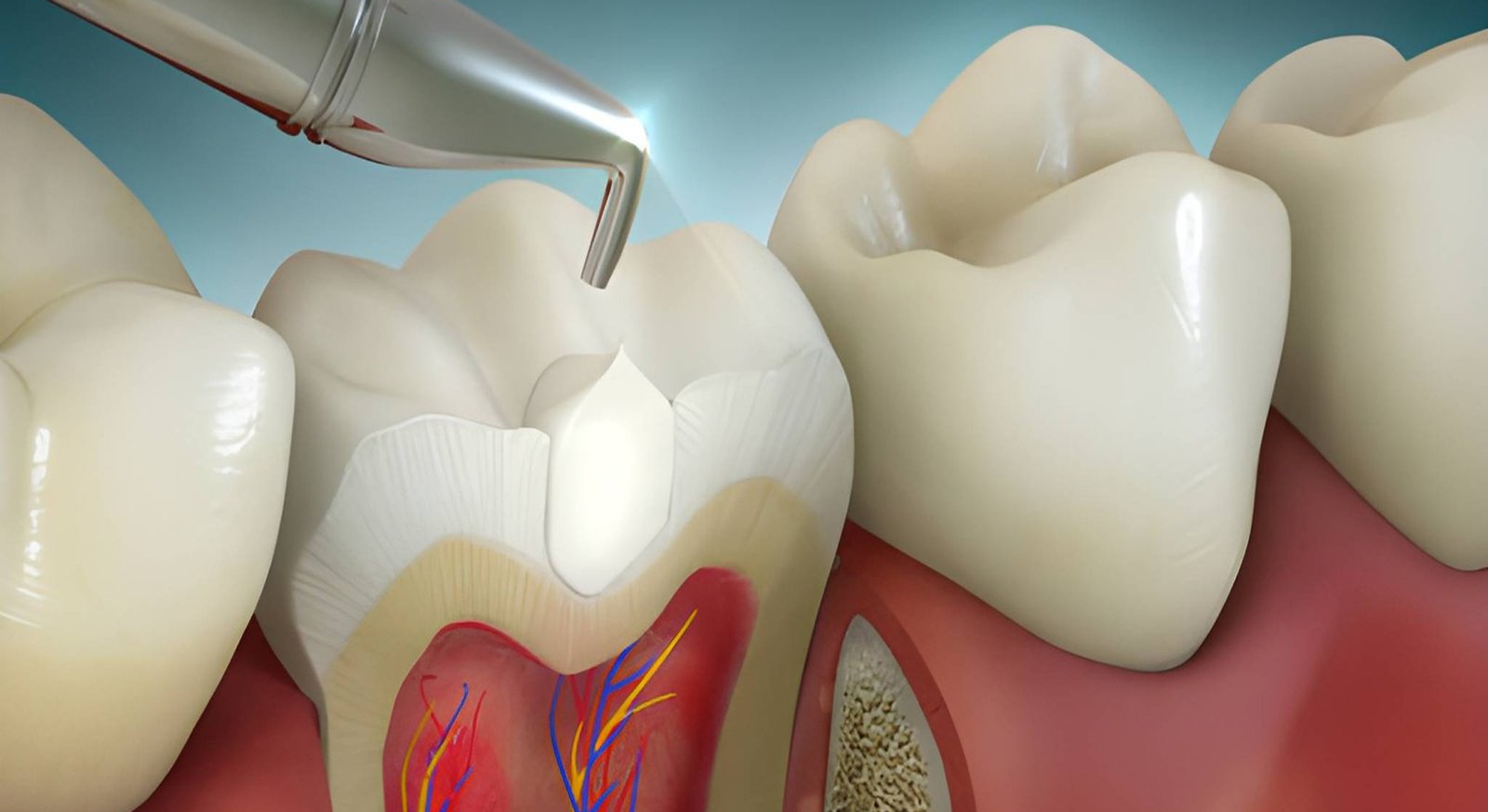 composite filling treatment