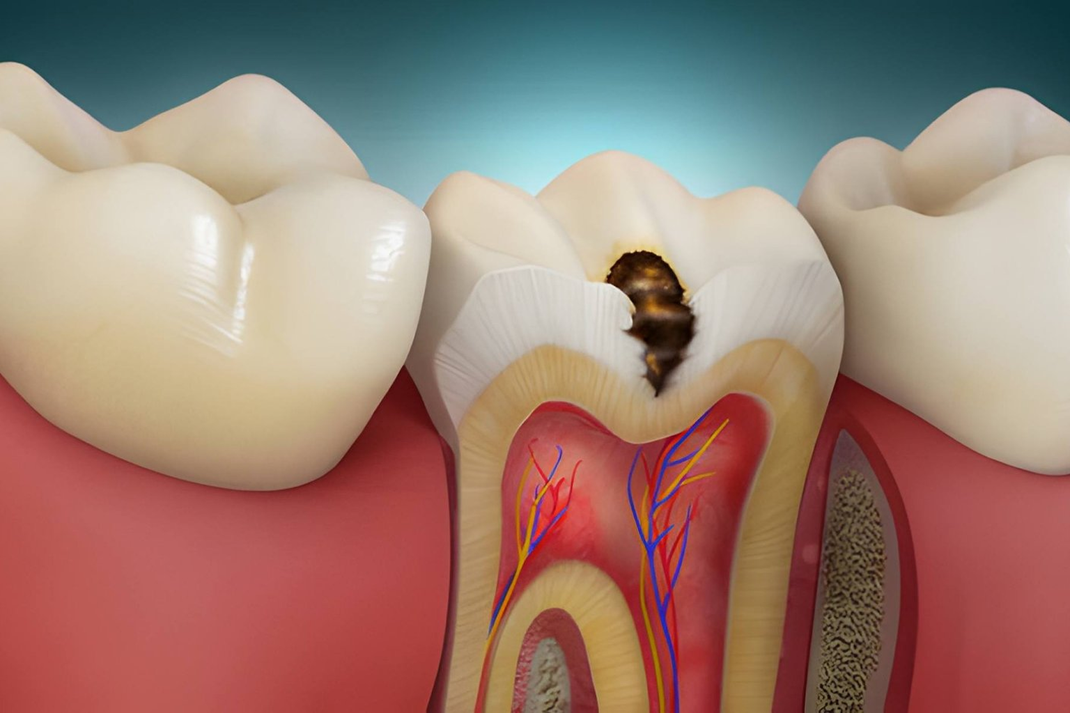 composite filling treatment