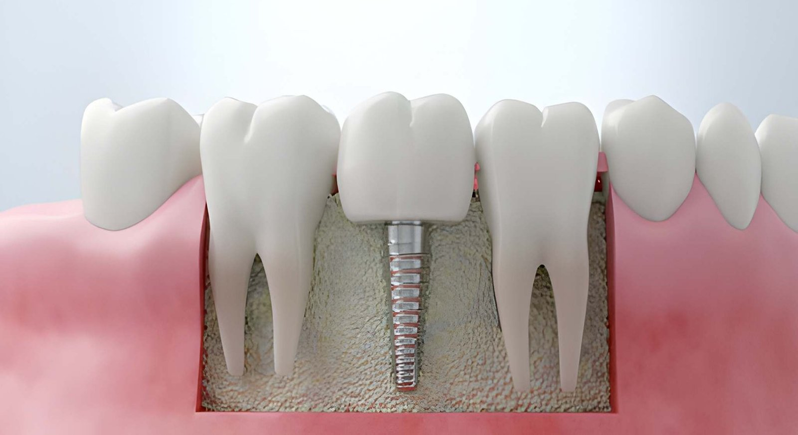 implant treatment
