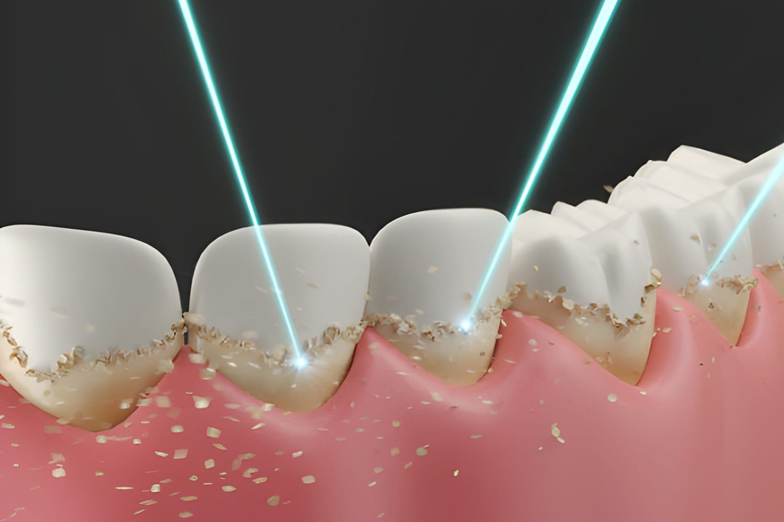 Laser Dentistry