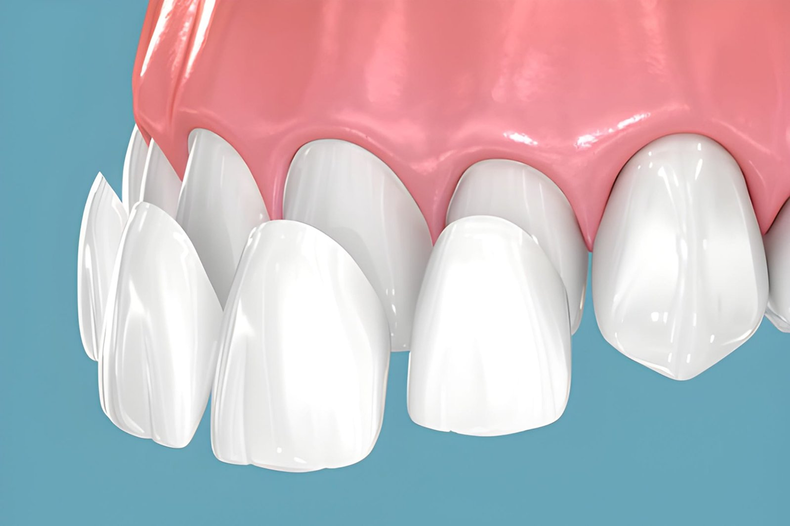 dental veneers